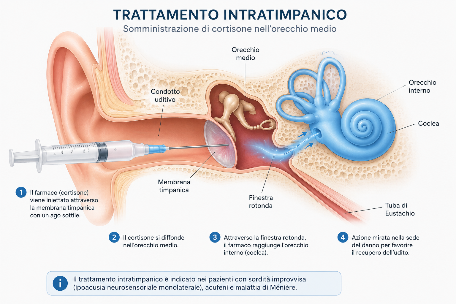 Trattamento intratimpanico